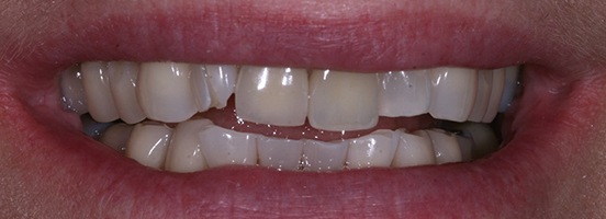 Before Before