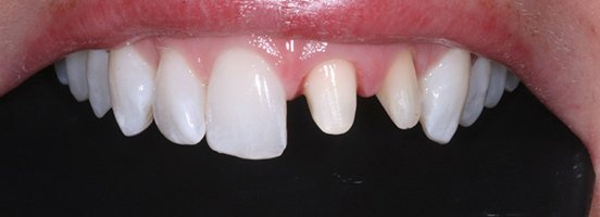 front tooth root canal