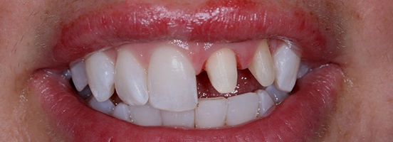 Before Before