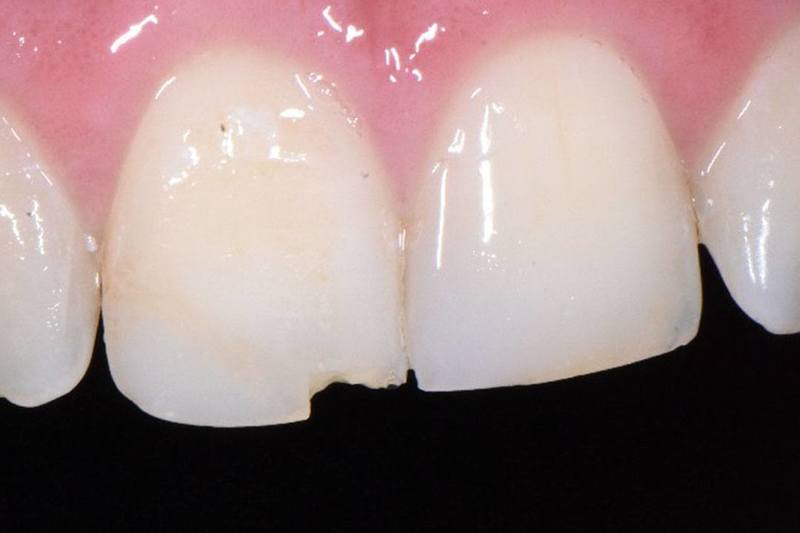 Before Before